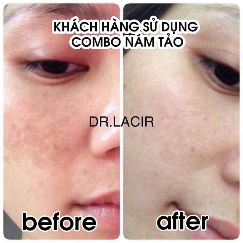 Combo nám tảo Dr. Lacir mờ nám phục hồi da làm trắng da tự nhiên LM56