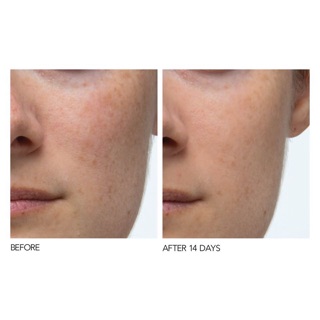 [DR. Dennis Gross] [Authentic] Miếng Peel Da Dr Dennis Alpha Beta Universal/Extra Strength Daily Peel