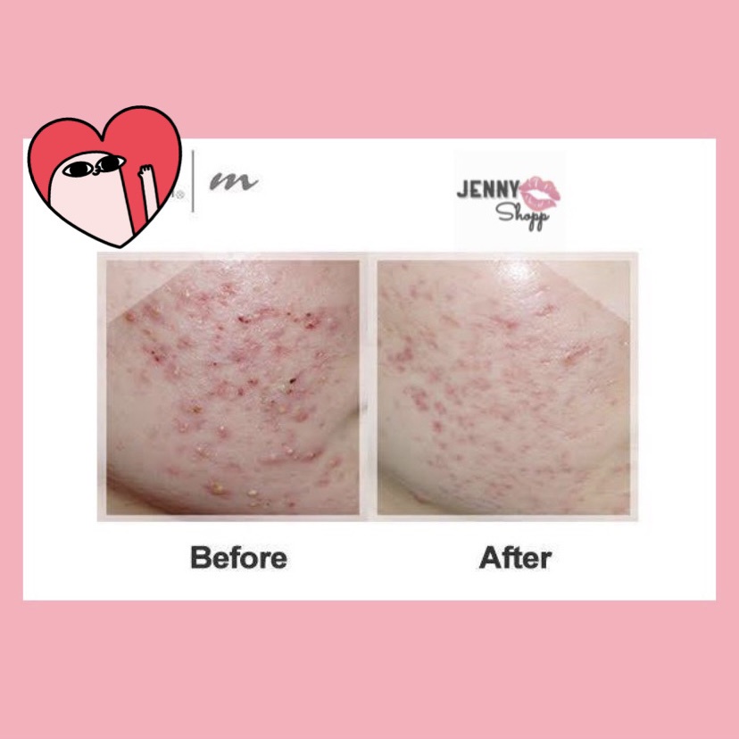 Viên Uống Giảm Mụn Pure Skin Clarifying Dietary Supplement 120 Viên