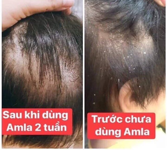 DẦU XẢ THIÊN NHIÊN AMLA CHIẾT XUẤT TỰ NHIÊN, CÂN BẰNG ĐỘ ẨM, SUÔN MỀM ÓNG MƯỢT GIÁ TỐT DẦU XẢ THIÊN NHIÊN AMLA