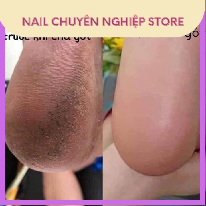 ĐẦU MÀI CHÀ GÓT + MIẾNG DÁN CHÀ GÓT