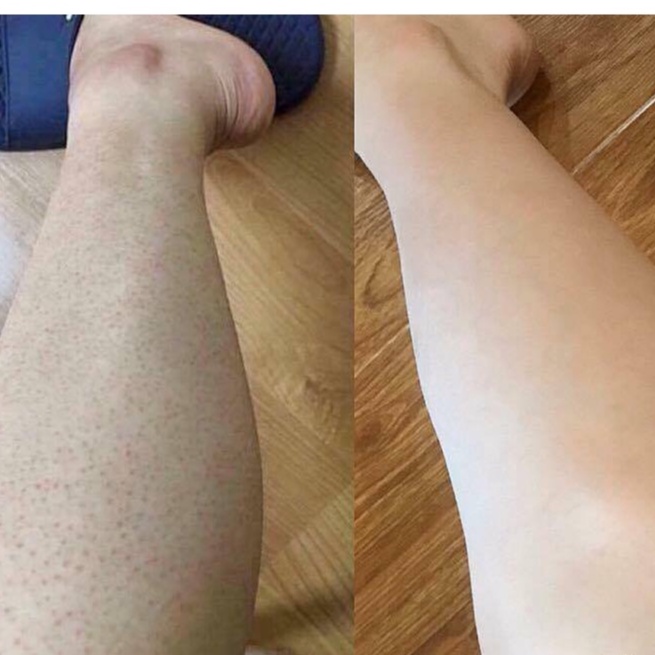 Kela Lotion 30ml Giảm Viêm Chân Nang Lông