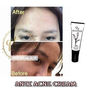 KEM TRỊ MỤN QTSKINCARE