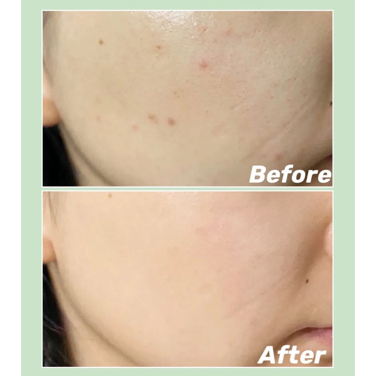 🦋giảm giá🦋Miếng pad tẩy da chết, hỗ trợ giảm mụn Stridex Daily Care Acne Pads with Salicylic Acid, Maximum Strength 55 Pads