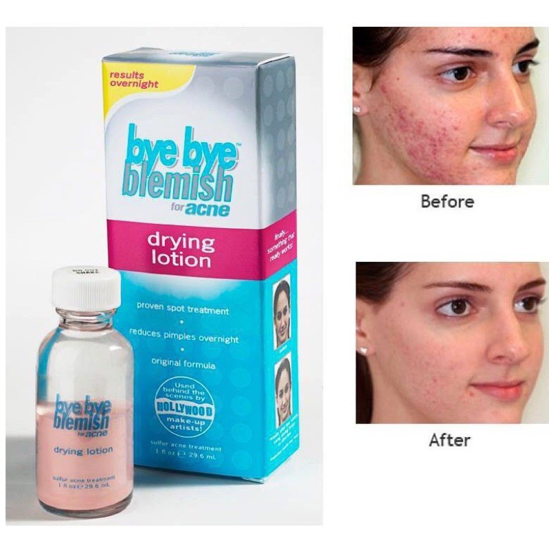 Chấm mụn Bye Bye Blemish For Acne Drying Lotion