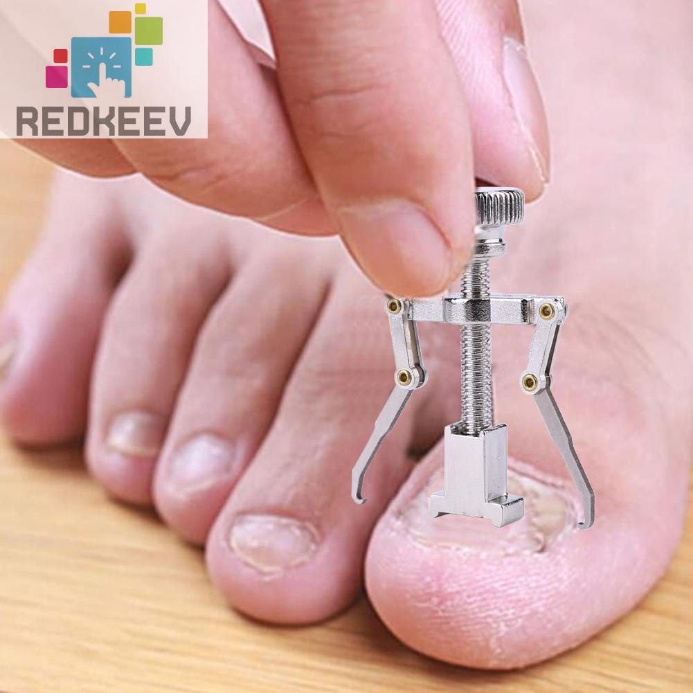 Dụng Cụ Chỉnh Sửa Móng Chân Mọc Ngược