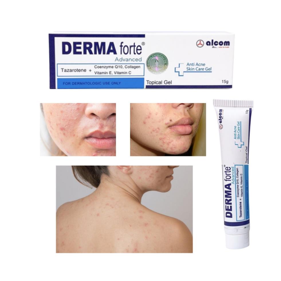 Gel Hỗ Trợ Giảm Mụn, Giảm Thâm Derma Forte Advanced Topical Gel 15g