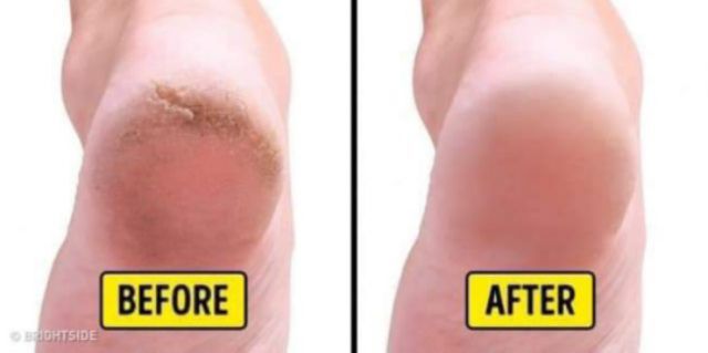 Kem nứt gót chân The banana Cream heels | BigBuy360 - bigbuy360.vn