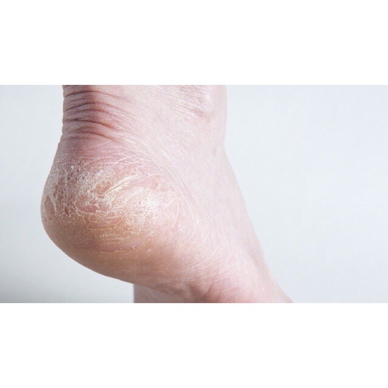 Kem dưỡng gót chân Neat Feat Heal Balm 120g.