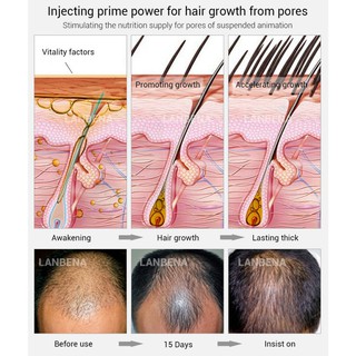 Xịt dưỡng kích mọc tóc nhanh chóng LANBENA