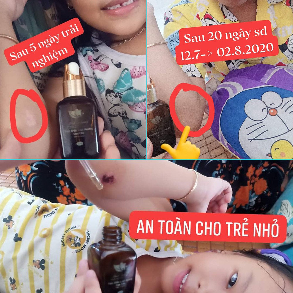 Tinh dầu Linh Hương làm mờ vết thâm da do sẹo, mụn ở mặt đầu gối, nách, nhũ hoa, côn trùng cắn 30ml