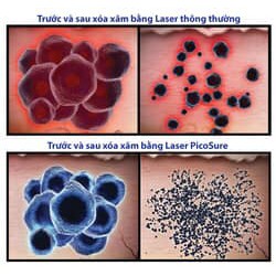 Máy laser xoá xăm picoway trục khửu