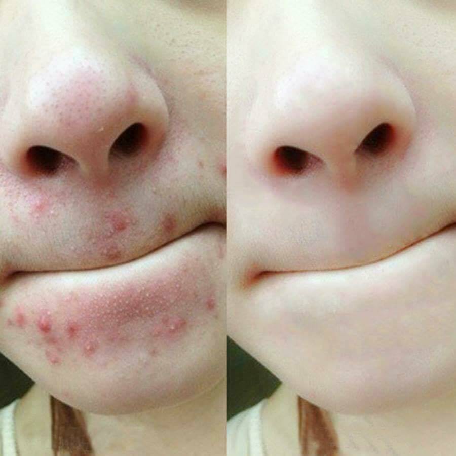 Tinh Chất Rau Má Hỗ Trợ Giảm Mụn Skin1004 Madagascar Centella 100 Ampoule