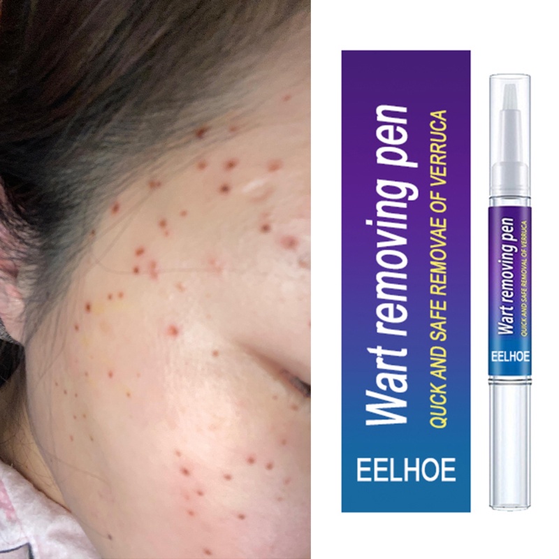 Bút Hỗ Trợ Giảm Mụn Thịt Thừa Cho Cơ Thể