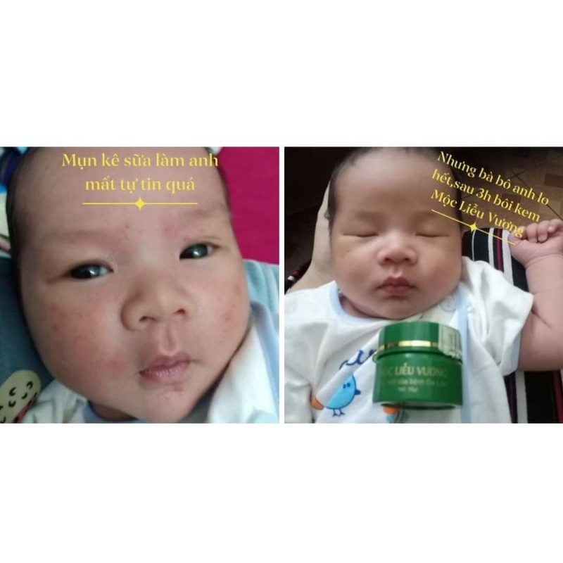 Kem bôi da Mộc liễu Vương_mẫu mới dạng tuyp tăng thêm 20% khối lượng