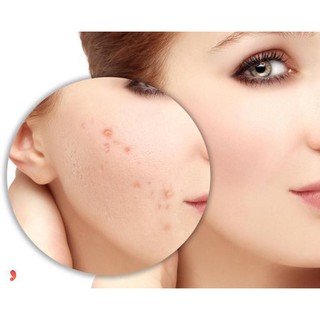 Contractubex Trị Sẹo Hiệu Quả
