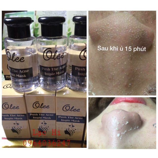 Tinh chất ủ trồi mụn