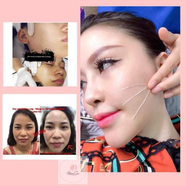 Cấy Chỉ Kim Cương SELINA Nâng Cơ Trẻ Hóa Da