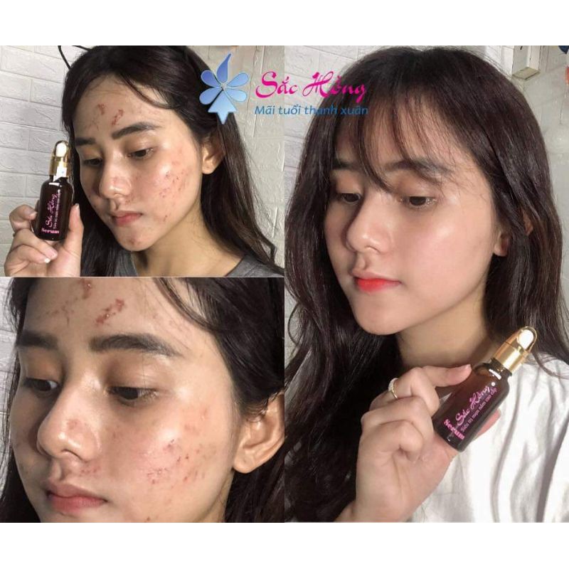 Serum Sắc Hồng cao cấp ngừa mụn - mờ nám 30ml | BigBuy360 - bigbuy360.vn