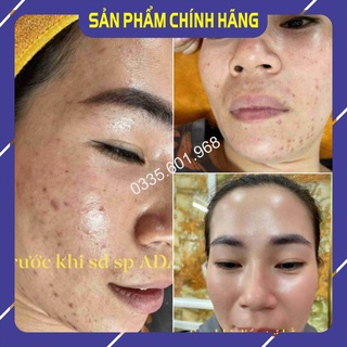 Bộ 5  Căng bóng- Trẻ hoá- ADA GROUP