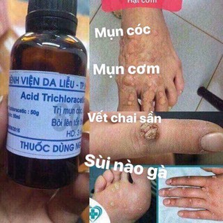 trị mụn cóc mụn cơm