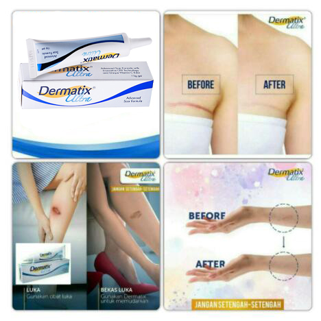 (Hàng Mới Về) Gel Làm Mờ Sẹo / Vết Rạn Da 15G Từ Mỹ Chất Lượng Cao | BigBuy360 - bigbuy360.vn