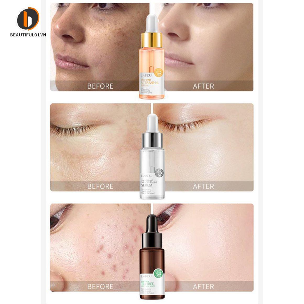 (Hàng Mới Về) Serum Trị Mụn Dưỡng Ẩm Kiểm Soát Dầu Làm Sáng Da Tự Nhiên