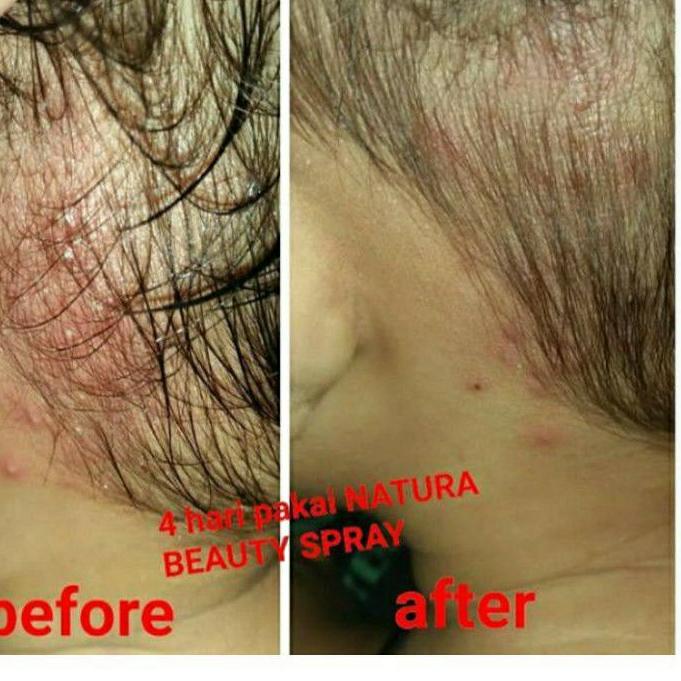 Cái thứ hai này! Tấm trải giường phun sương làm đẹp Lr075 Natura NBS Beuty Biuty Sprey Natura | BigBuy360 - bigbuy360.vn