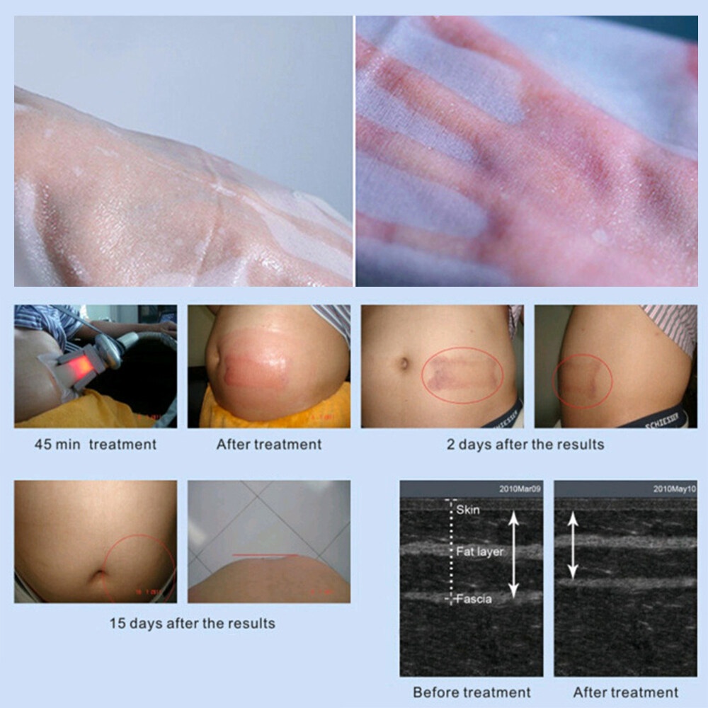 Màng chống đông Foreverlily hỗ trợ da không bị tê cóng cho liệu pháp cryo