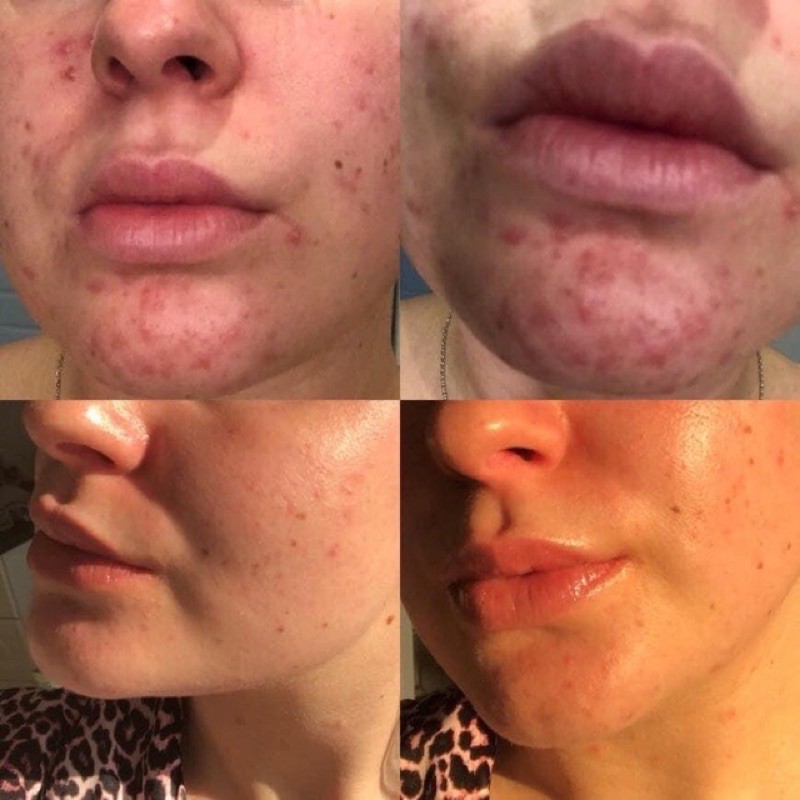 Kem bôi giảm mụn Acetin A 0.025% và 0.05% - Acetin A | BigBuy360 - bigbuy360.vn