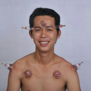 Bộ giác hơi không dùng lửa Duy Thành YGH04