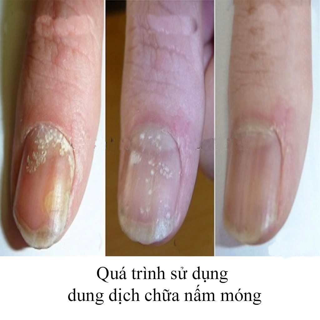 Dung dịch cải thiện nấm móng Fungus Killer nhập khẩu từ Mỹ chính hãng (7ml)