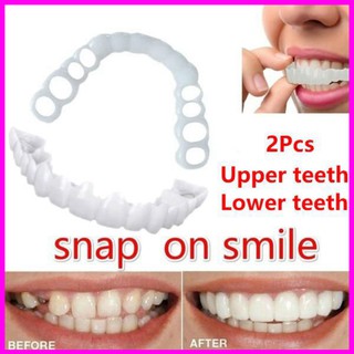 [BÁN CHẠY] Dụng cụ niềng răng tại nhà snapon smile - nẹp răng tại nhà