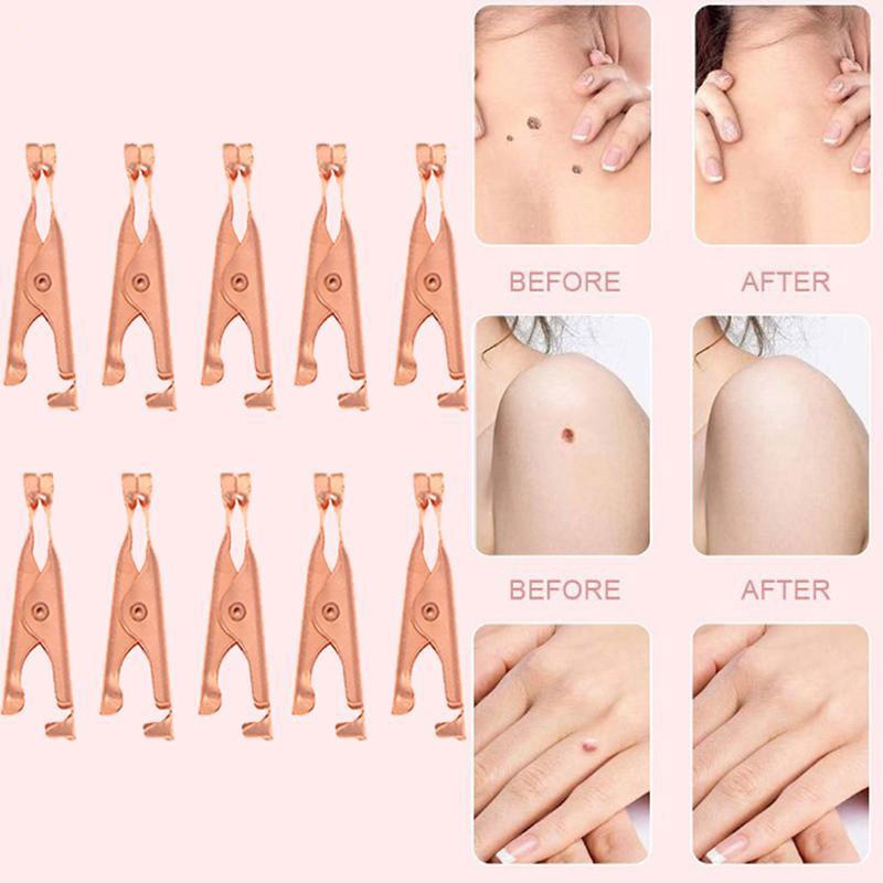 Bộ 2 Kẹp Loại Bỏ Mụn Trứng Cá / Vết Thâm Tức Thì Tiện Dụng Cho Mọi Lứa Tuổi