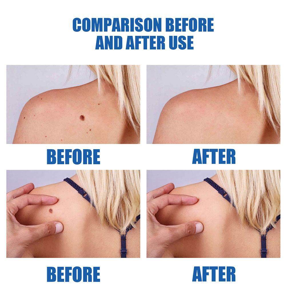 Skin Thẻ Bút Xóa Nốt Ruồi, Thẻ Da An Toàn Di Động, Nốt Ruồi Remover