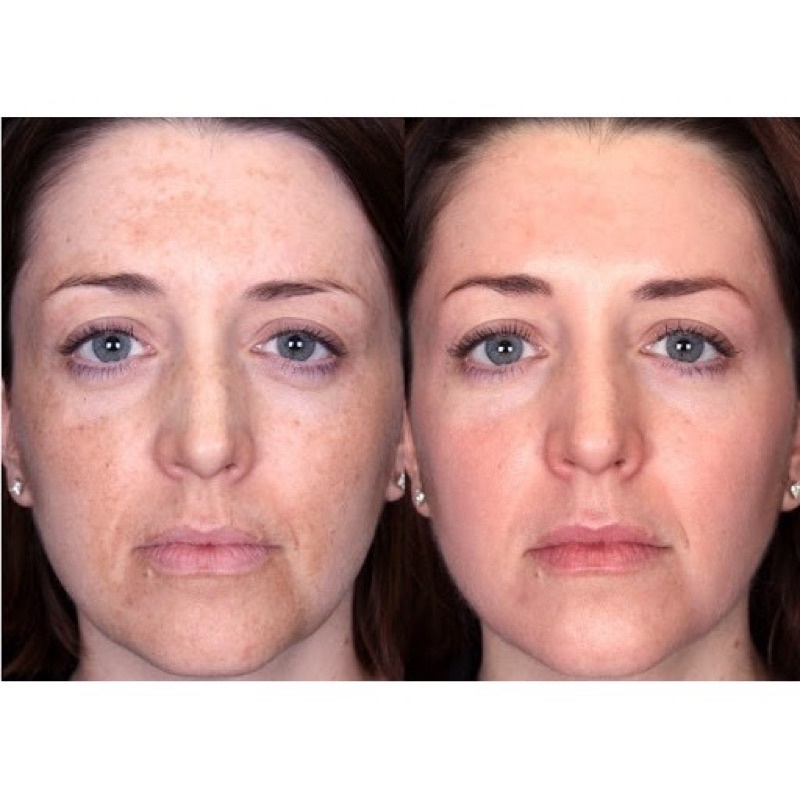 ✅ Neostrata Peel Tái Tạo Da, Giảm Nếp Nhăn Ngăn Ngừa Lão Hóa Prosystem Retinol Peel 1.5ml