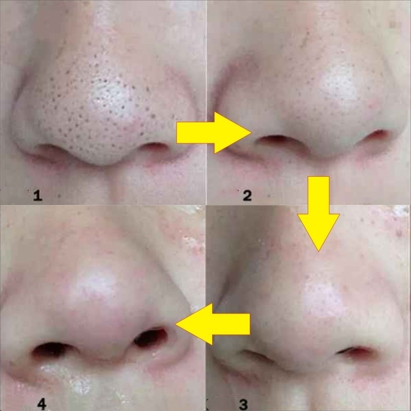 Set 10 Miếng Dán Lột Mụn Đầu Đen Làm Sạch Sâu Cho Mũi