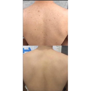Xà phòng giảm mụn lưng for back