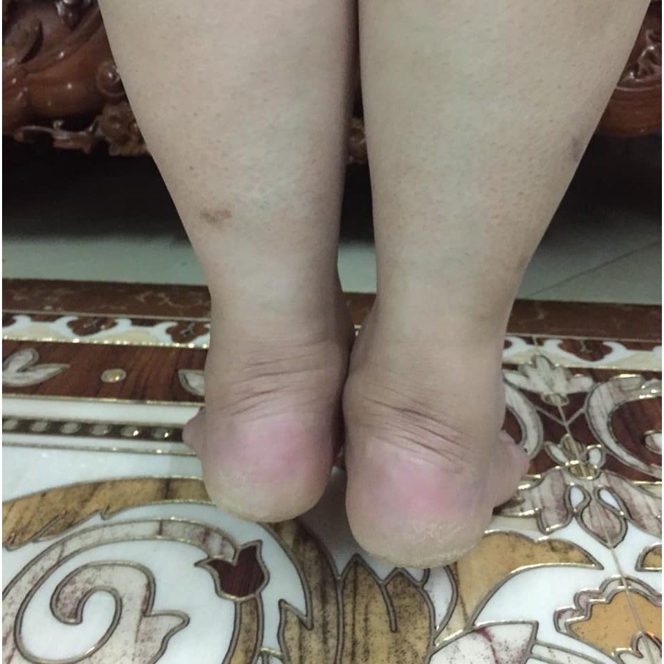 Bôi nứt gót chân bảo hành khỏi 100% | BigBuy360 - bigbuy360.vn