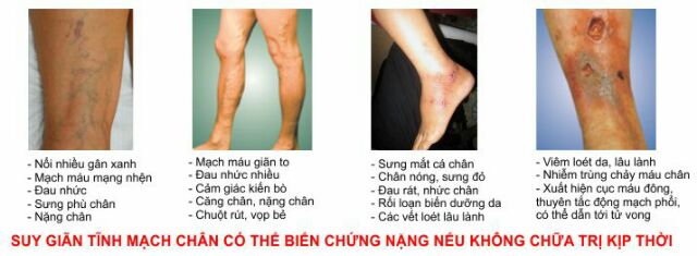 KEM GIẢM SUY GIÃN TĨNH MẠCH VARIKOSETTE