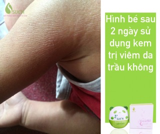 KEM TRỊ VIÊM DA TRẦU KHÔNG SUE’N