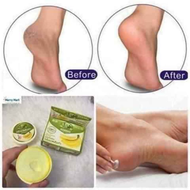 Kem chuối trị nứt gót chân Thái Lan