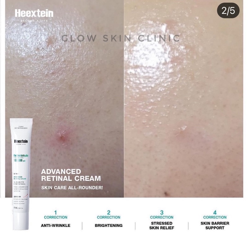 Kem dưỡng ngăn ngừa mụn, chống lão hoá Retinaldehyde Heextein