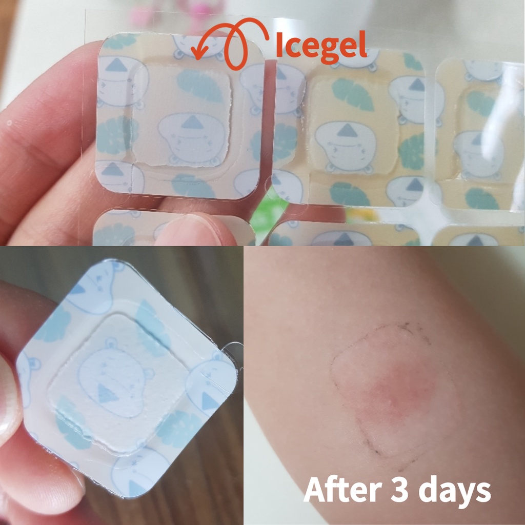 Miếng dán gel lạnh Hamsoa làm dịu vết muỗi và côn trùng đốt cho bé