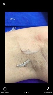 peel da nách mông bẹn medicos