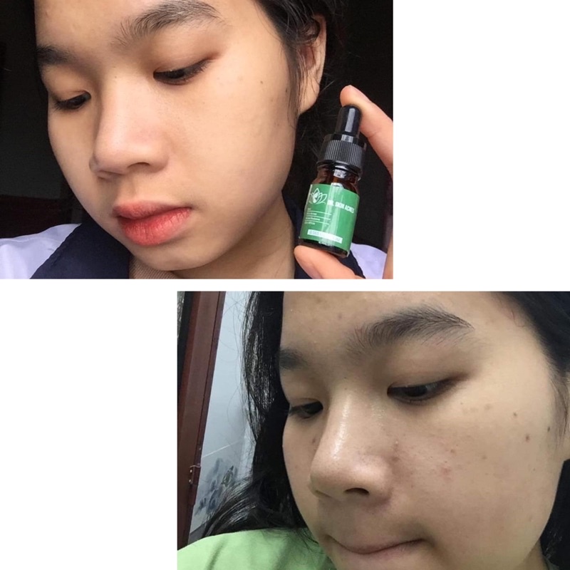 Serum mụn drskinbeauty, serum giảm mụn, mờ thâm