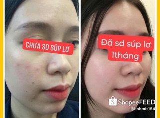 Combo Serum & Kem Face Suplo 🥦🥦🥦