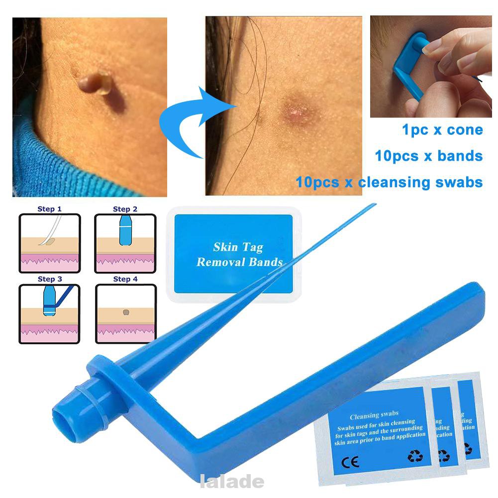 Adult Blue Body Non Toxic Corn Micro Band With Cleansing Swabs For Small To Medium Skin Tag Removal Kit