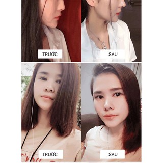 Bộ dụng cụ nâng mũi 3D Hàn Quốc