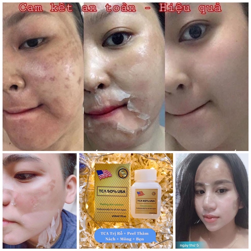 TCA50% 🇺🇸 Phá cắt đáy, lấp đầy sẹo rỗ, sạch thâm mụn, nám tàn nhan, da không đều mầu, làm Hồng ti, peel nách, Mông bẹn..